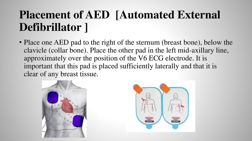 Automated External Defibrillator Pad Placement